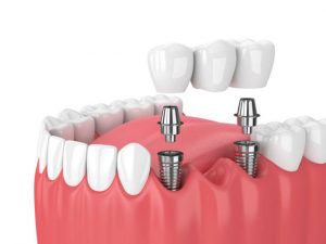 dental implants