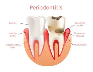 Periodontal