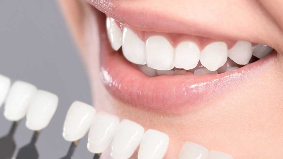 Teeth Whitening Melbourne